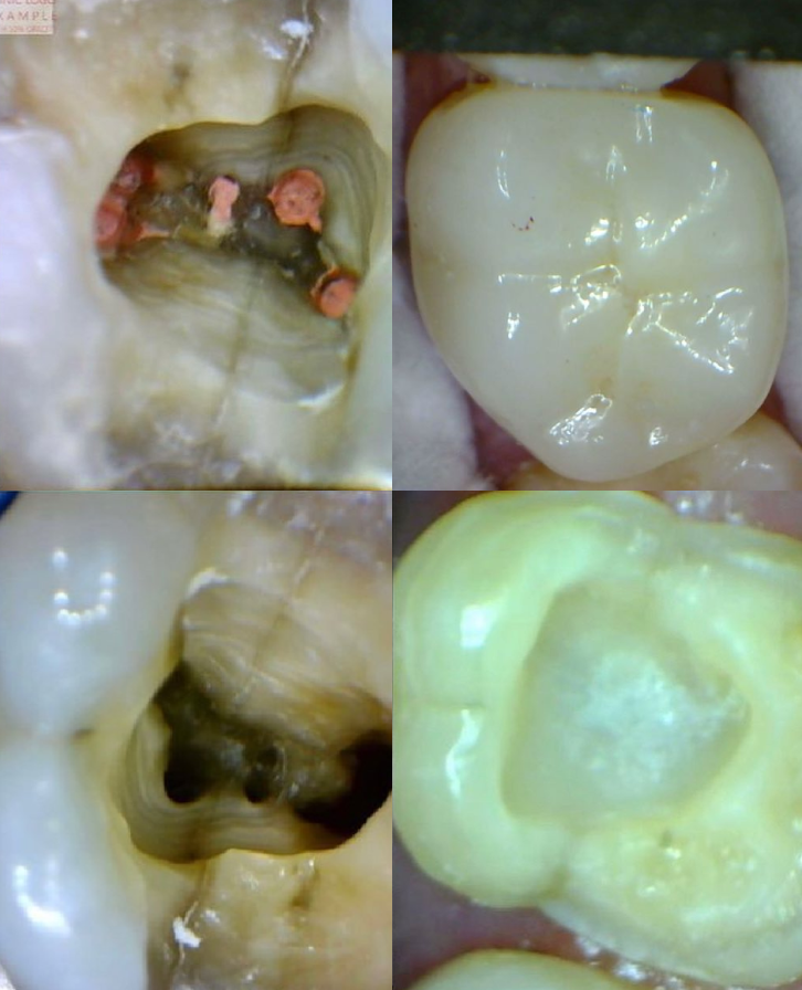 SkyCam - Aplicação na Endodontia