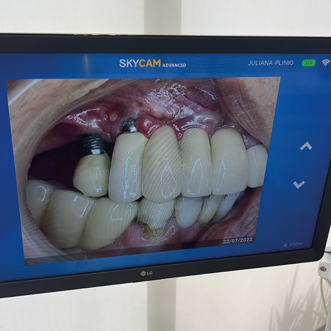 Camera intraoral periodontia SkyCam